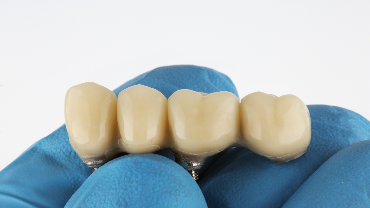 Embracing Advance Zirconia: Redefining Dental Excellence with Cutting-Edge Materials