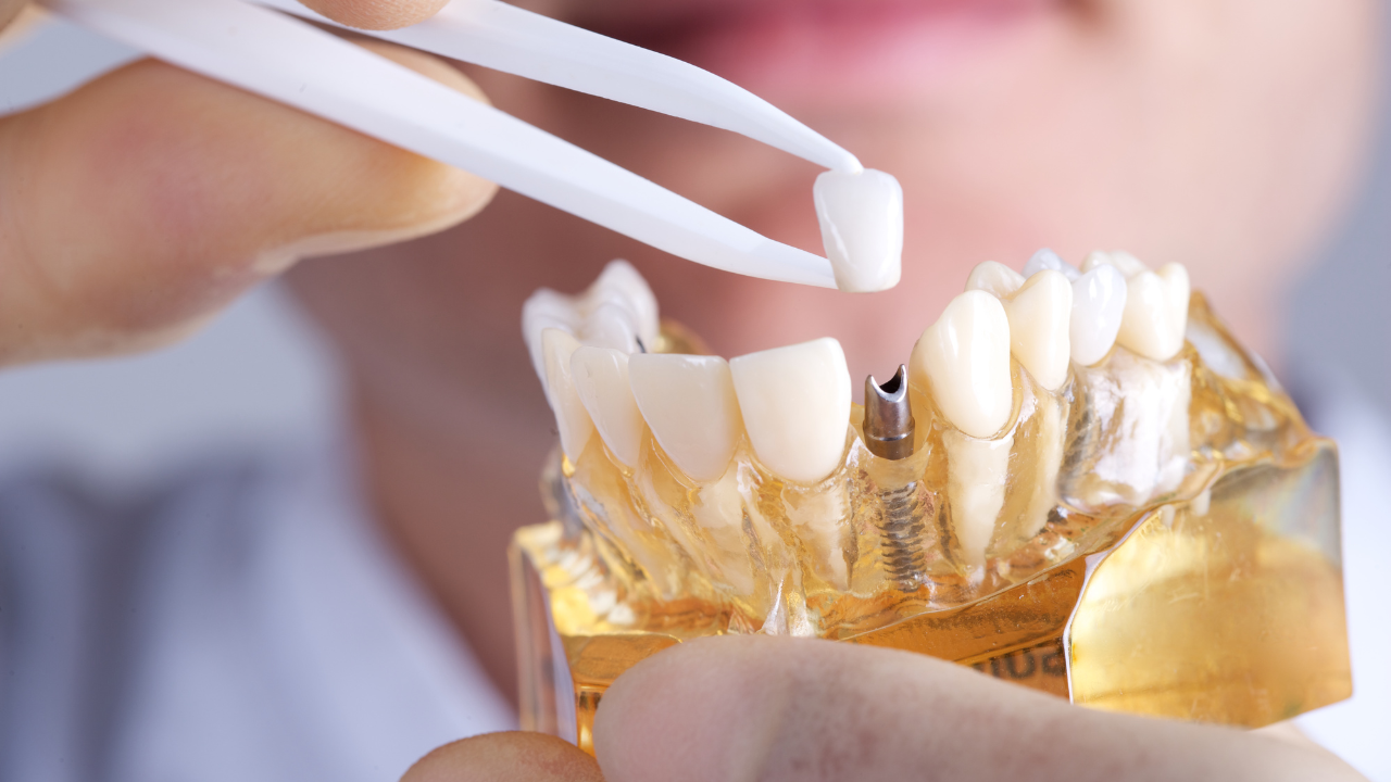 Smile Bright: Mastering Dental Care Essentials for Your Dental Implants