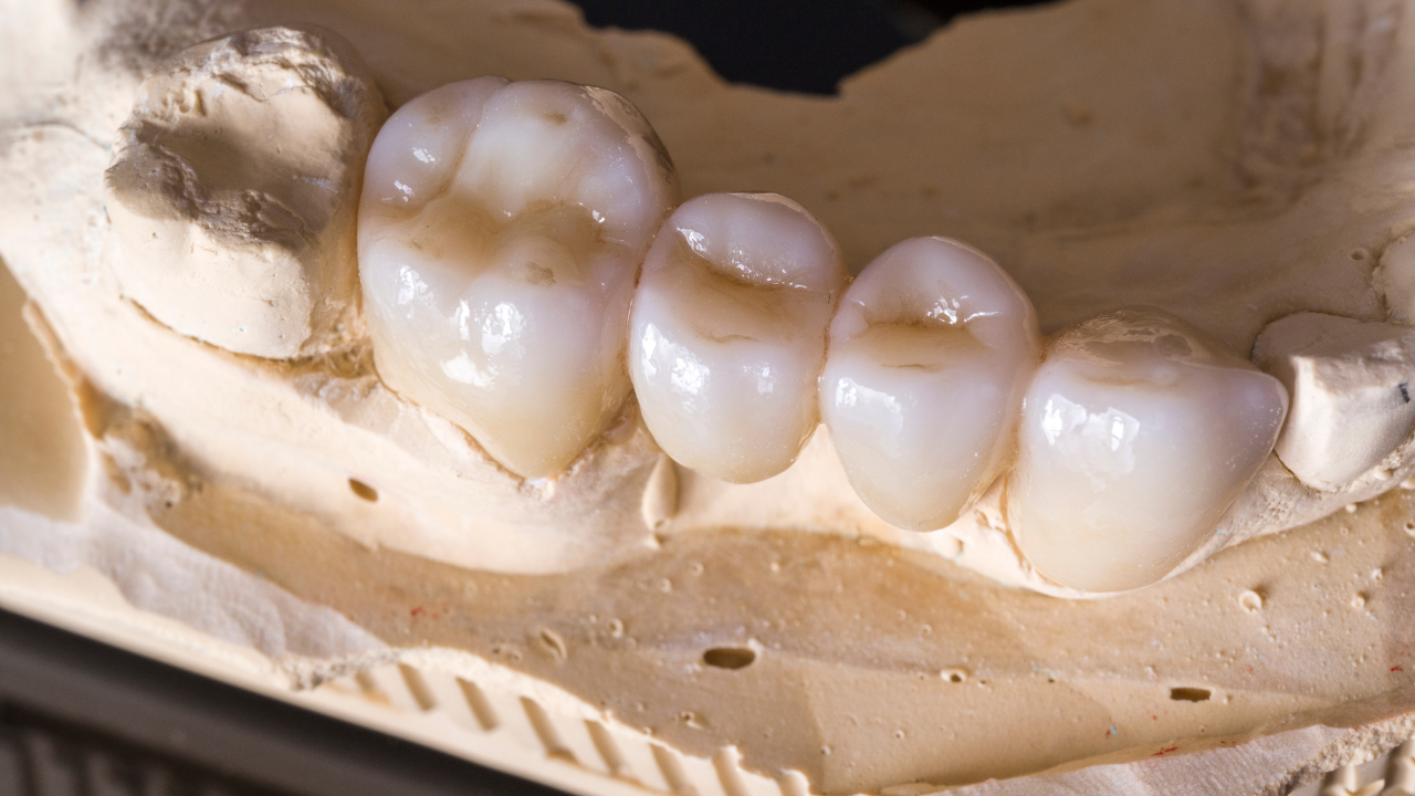 The Revolution of Dental Crowns: Embracing Monolithic Zirconia Over PFM