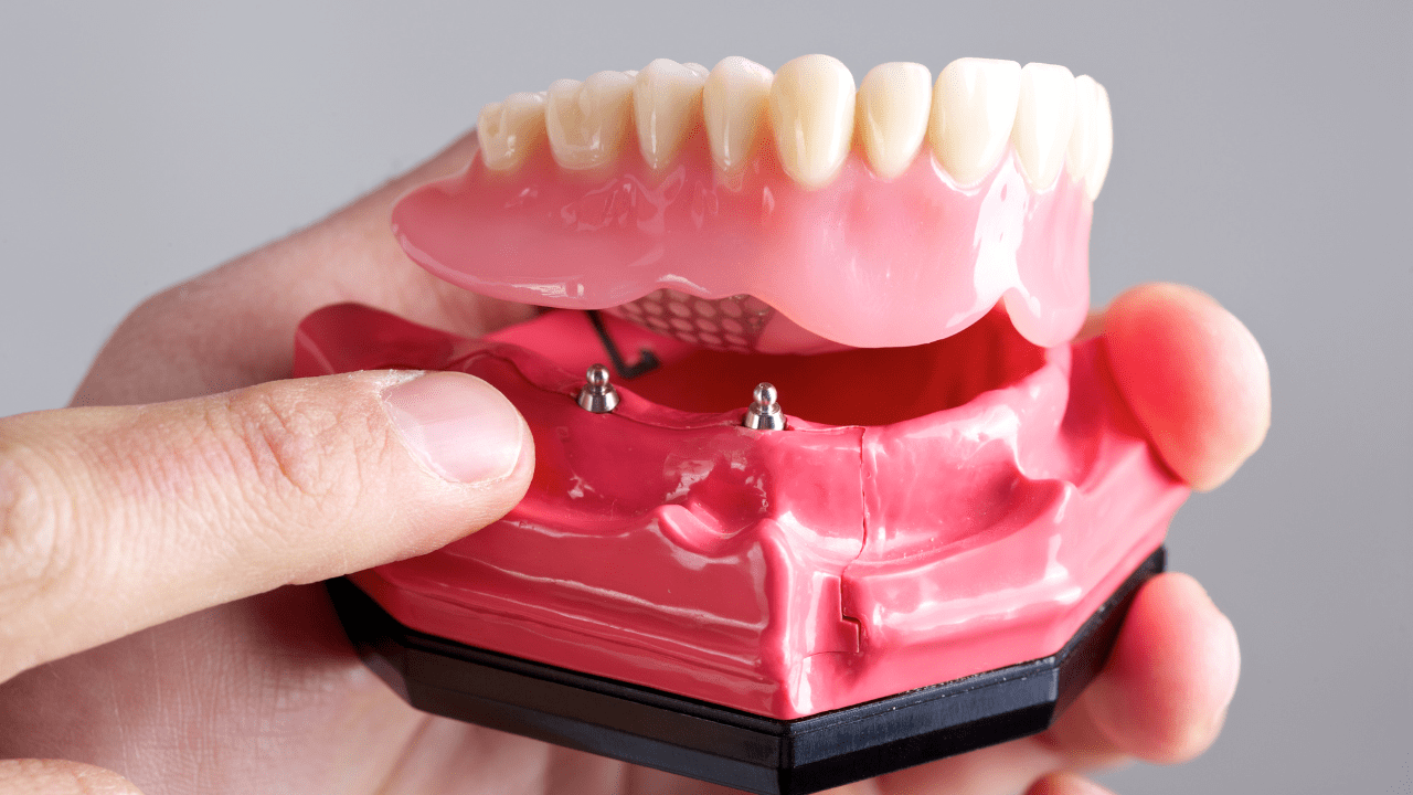 Why You Must Refrain from using Cheap Dental Implants?