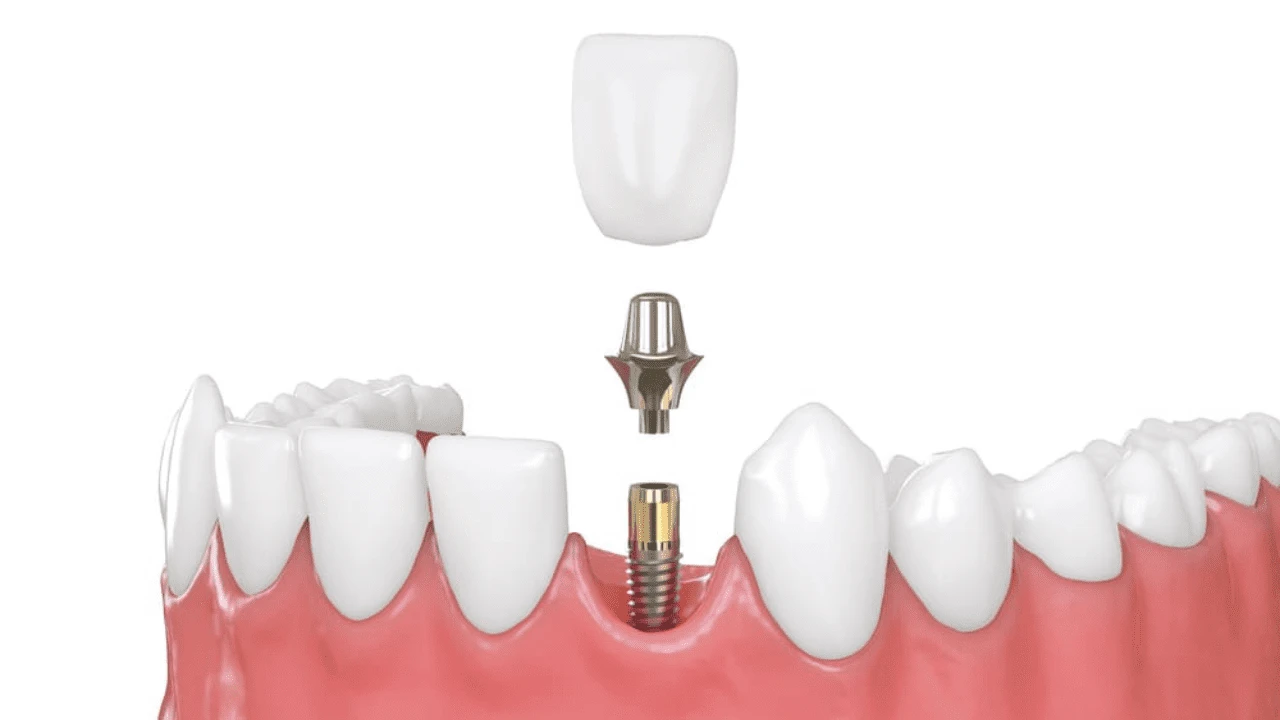 Dental Abutment Teeth Complete Guide, Types & Parts