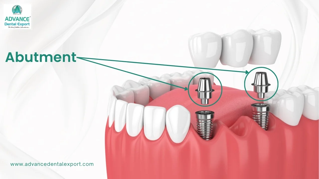 Abutment-The-Critical-Link