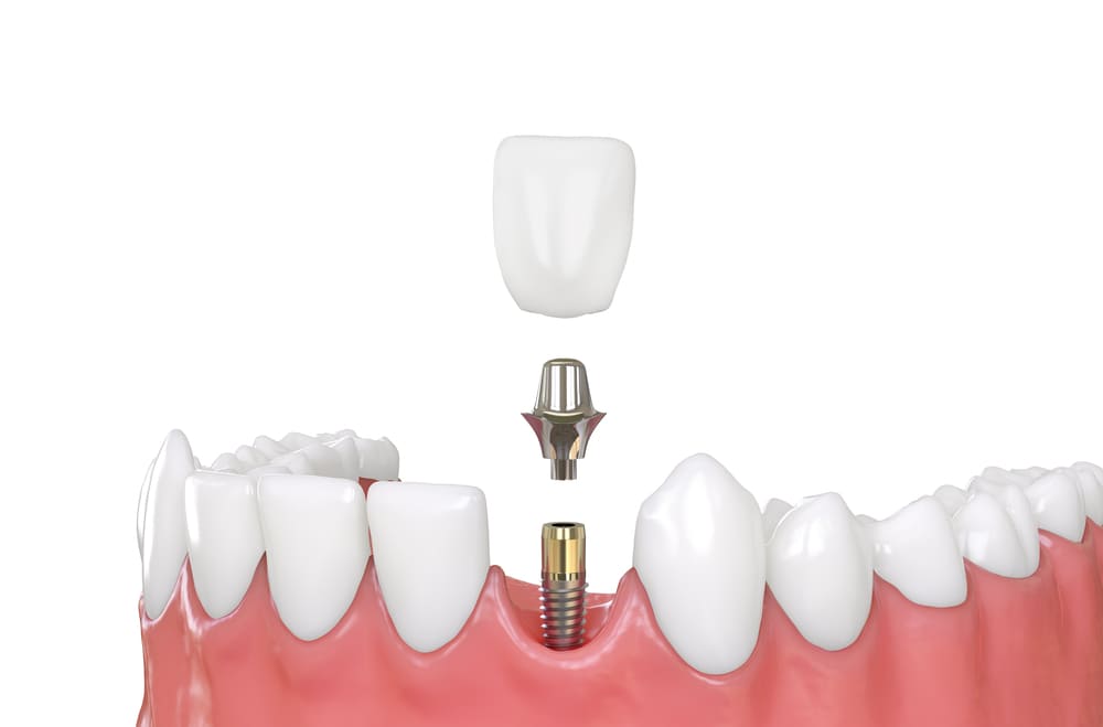 All You Need To Know About AD-Abutments | Products, Process & Variety | ADE