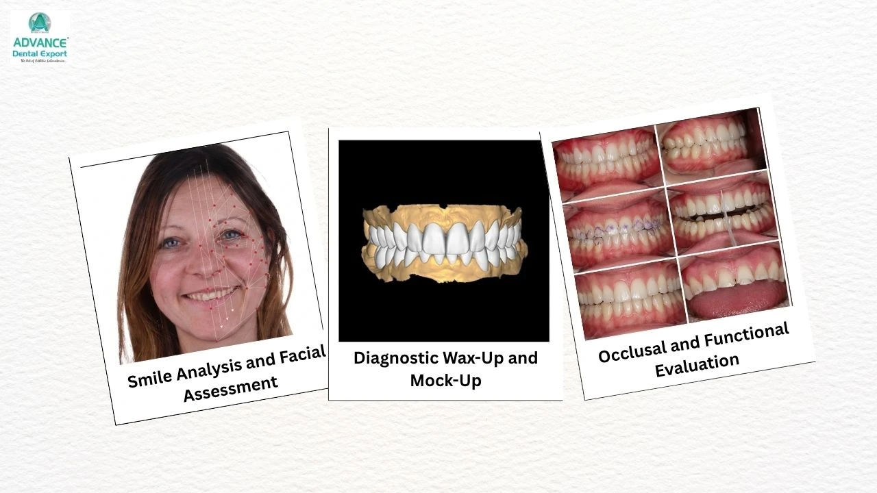 Diagnostic-Planning-Before-Preparing-Teeth-for-Veneers