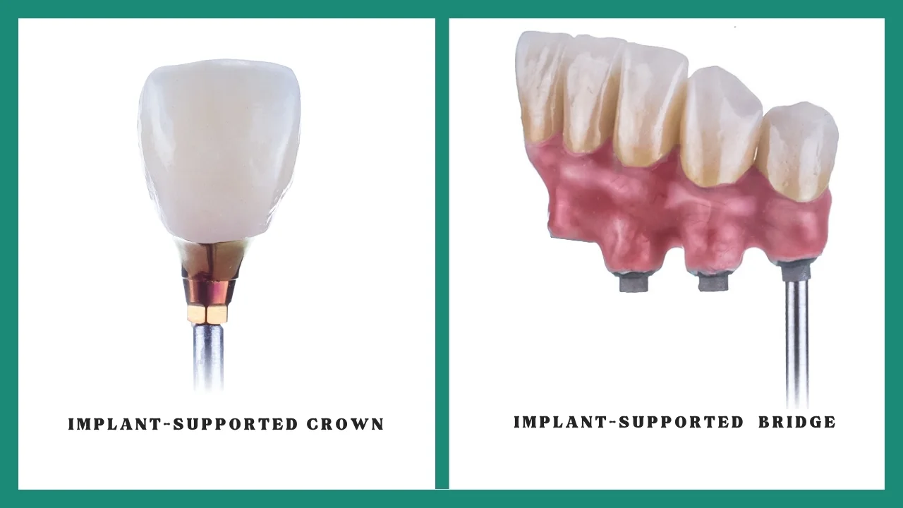 Implant-Supported-Crown-vs-Bridge-Clinical-Comparison
