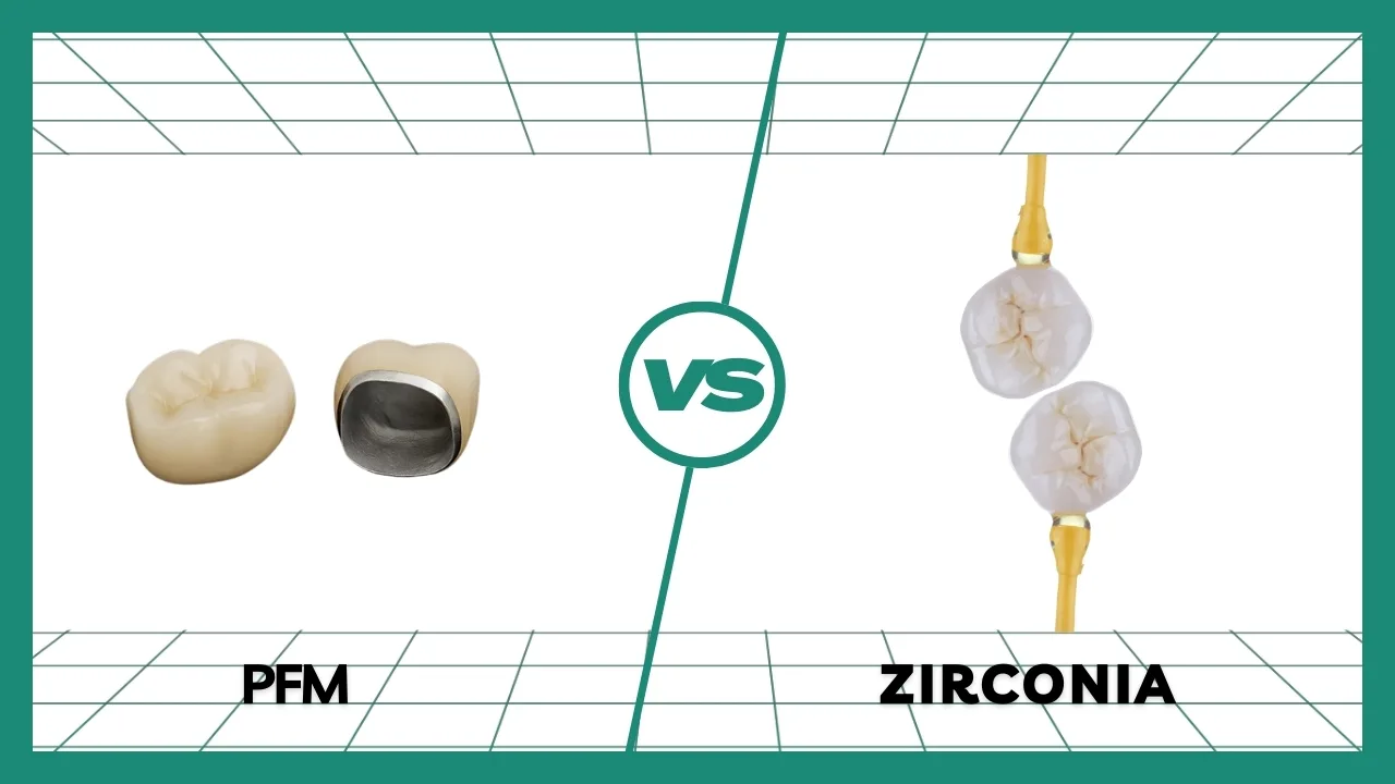 PFM vs Zirconia Crown: Comparative Guide for Dentists
