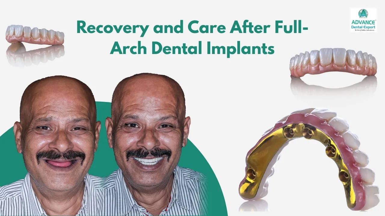 Full-Arch Dental Implant Recovery & Aftercare Guide 2026