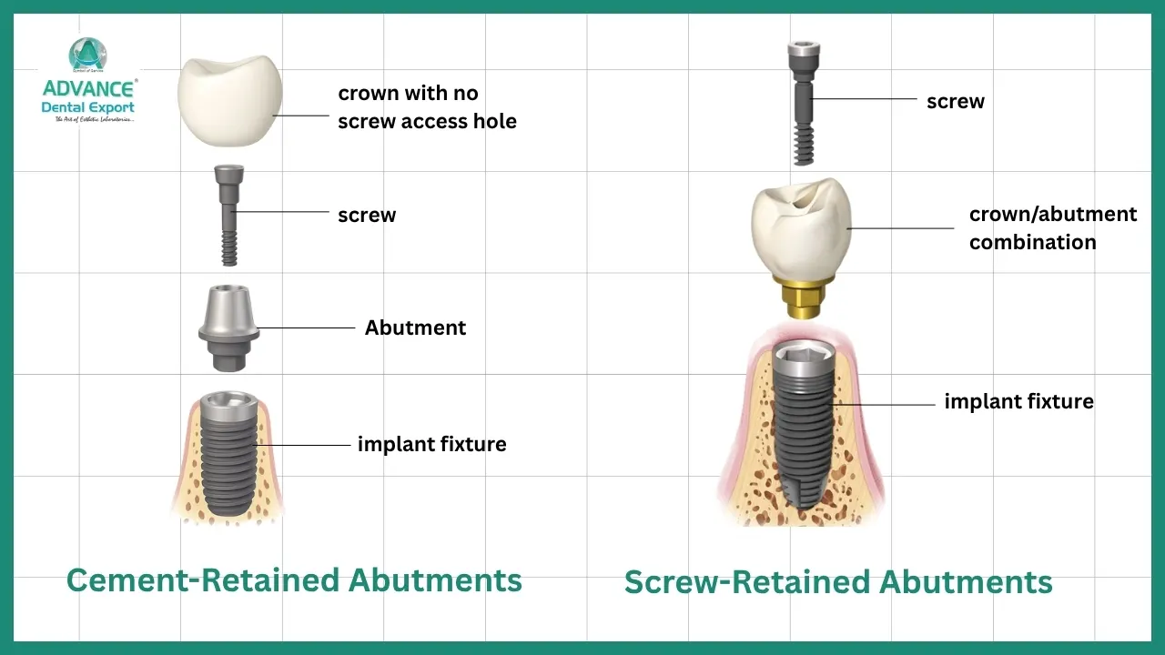 Types-of-Dental-Abutments