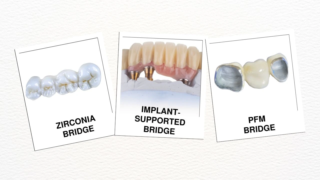 Types-of-Dental-Bridges-&-Their-Cost-in-India