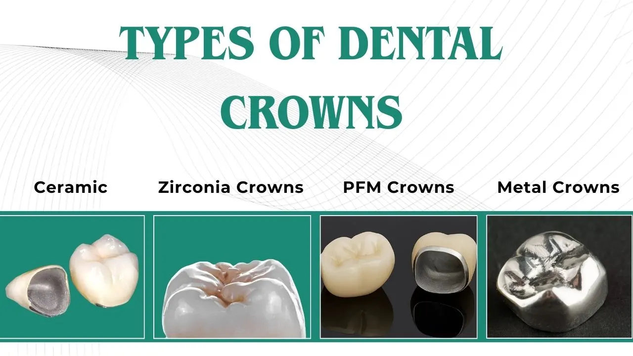 Types-of-Dental-Crowns-Materials-&-Options