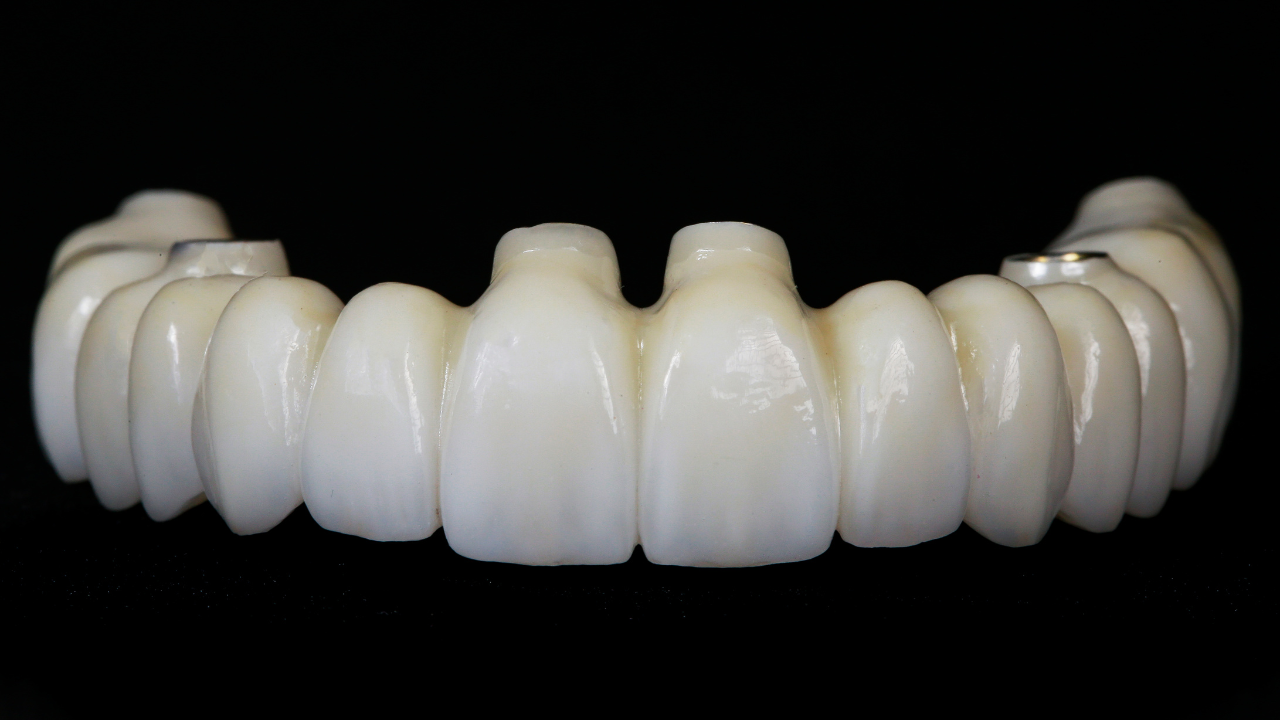 A Comprehensive Guide to Choosing the Optimal Dental Implants Prosthesis for Your Unique Needs