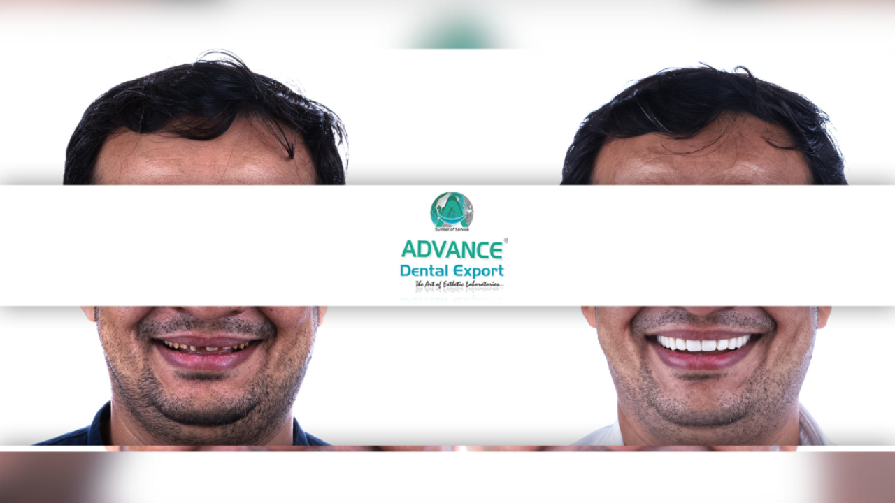 Unveiling the Magic: Transform Your Smile with HOLLYWOOD SMILE - Advance Dental Export