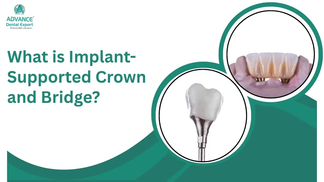 What is Implant-Supported Crown and Bridge? Explore Its Benefits