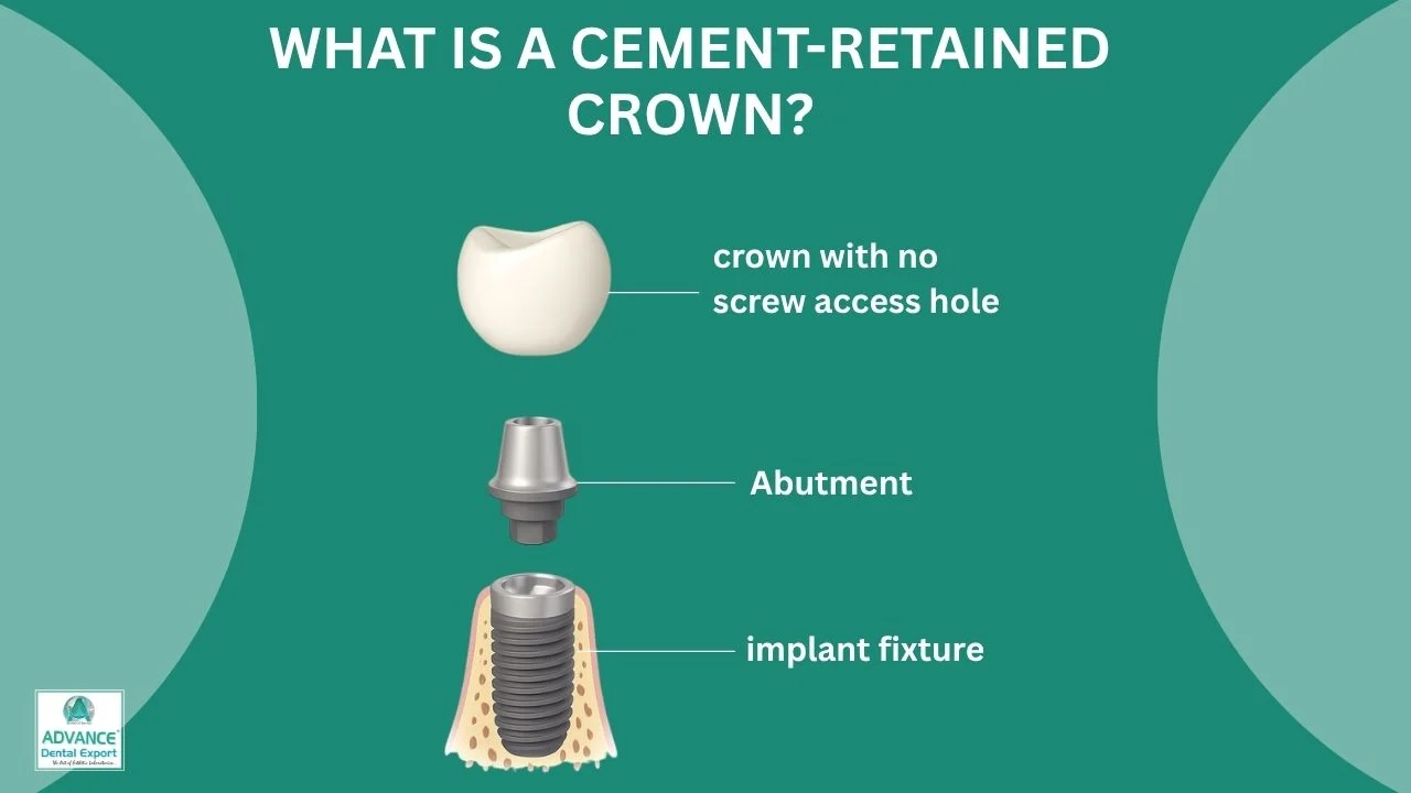 What-is-a-Cement-Retained-Crown