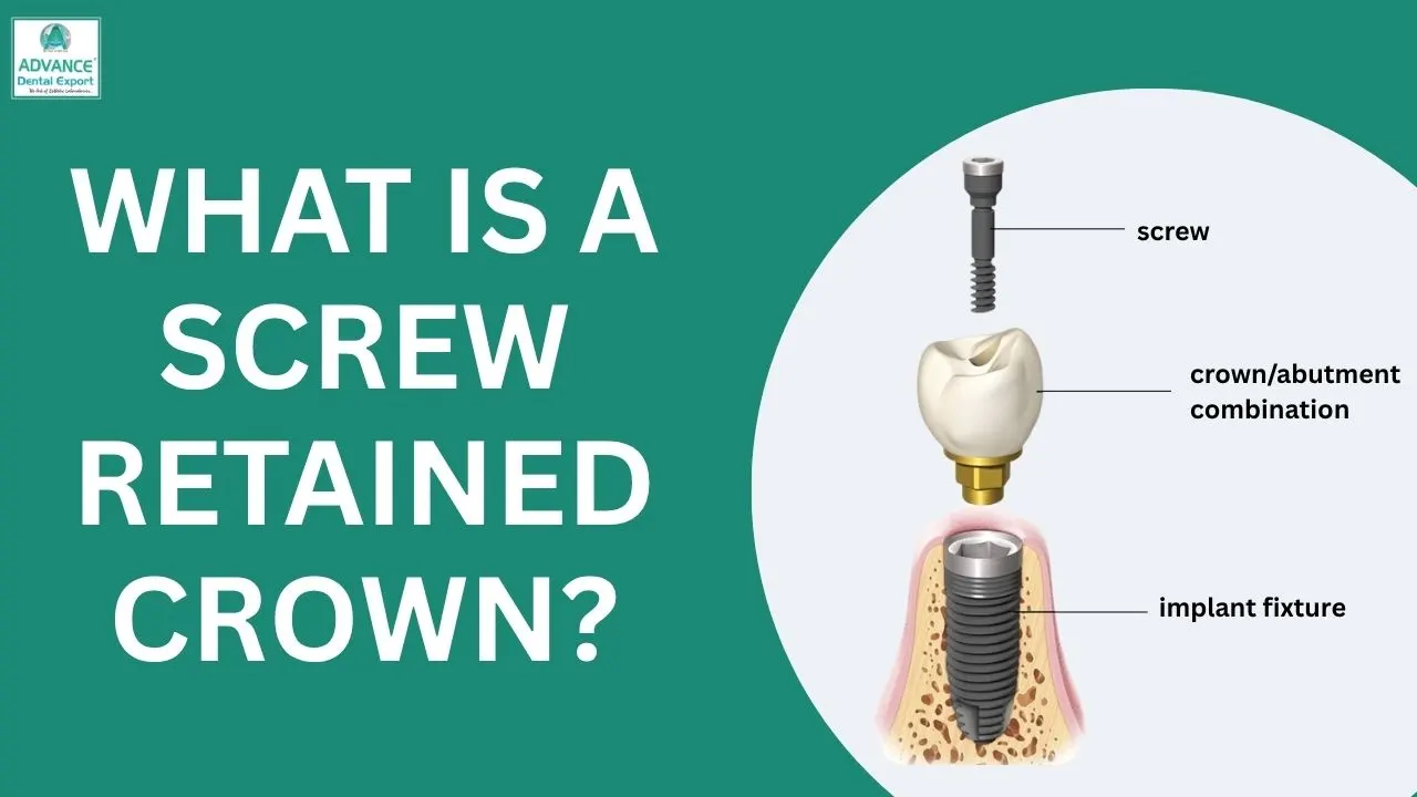 What-is-a-Screw-Retained-Crown