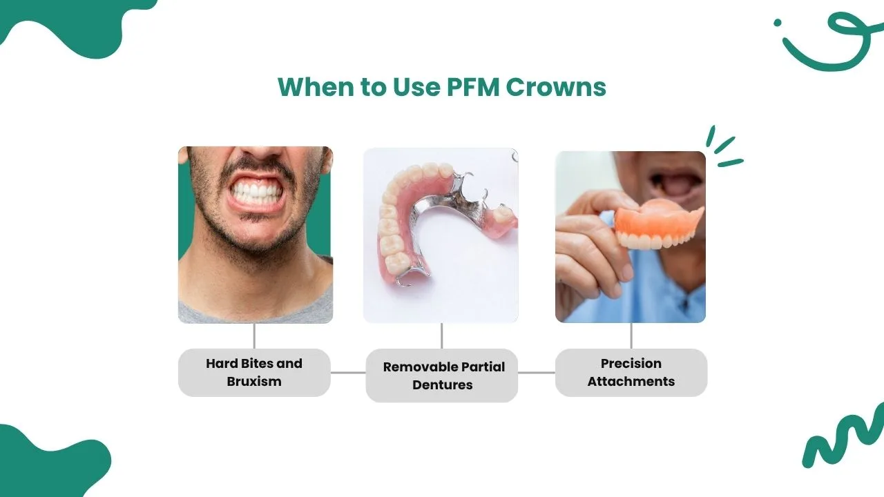 When-to-Use-PFM-Crowns