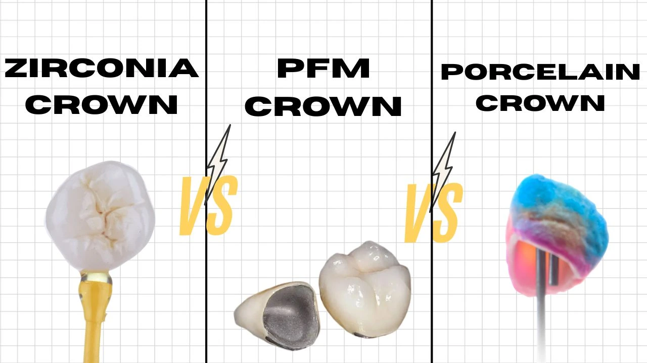 Zirconia-vs-PFM-Crown-Cost-Is-It-Worth-Paying-More